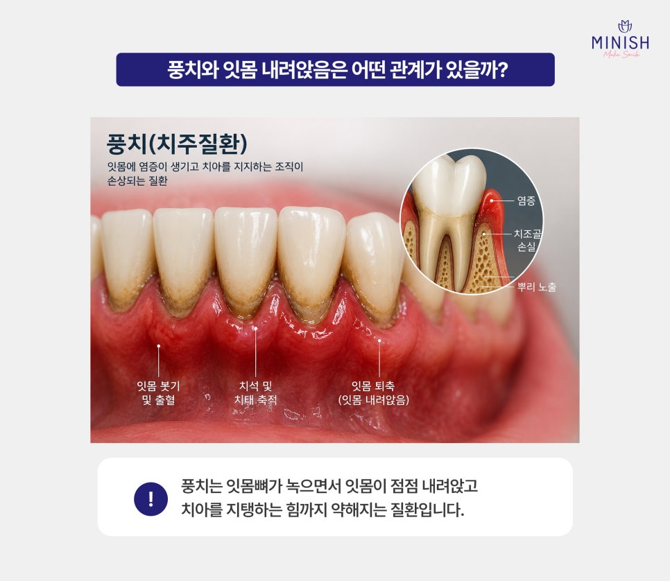 Causes of Receding Gums, Early Signs of Gum Disease, and When Gum Disease Treatment Is Needed image 4