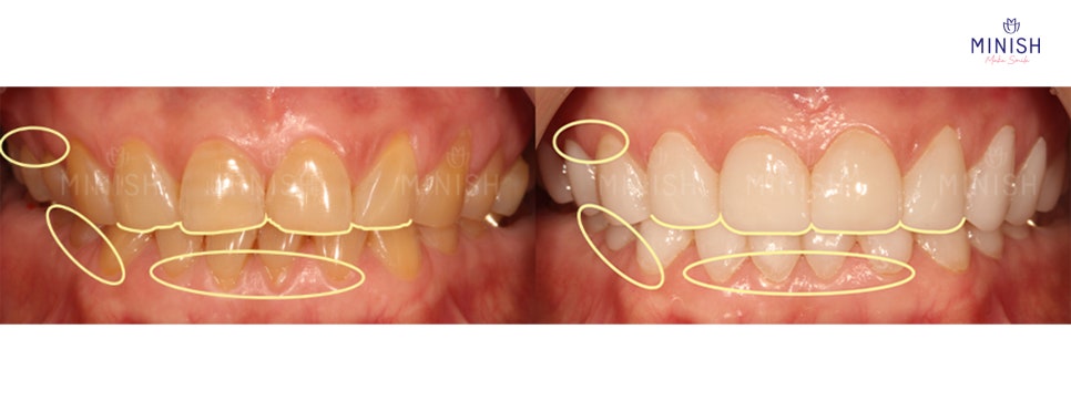 Tooth Wear: What Causes It? How to Restore Teeth Healthily image 3