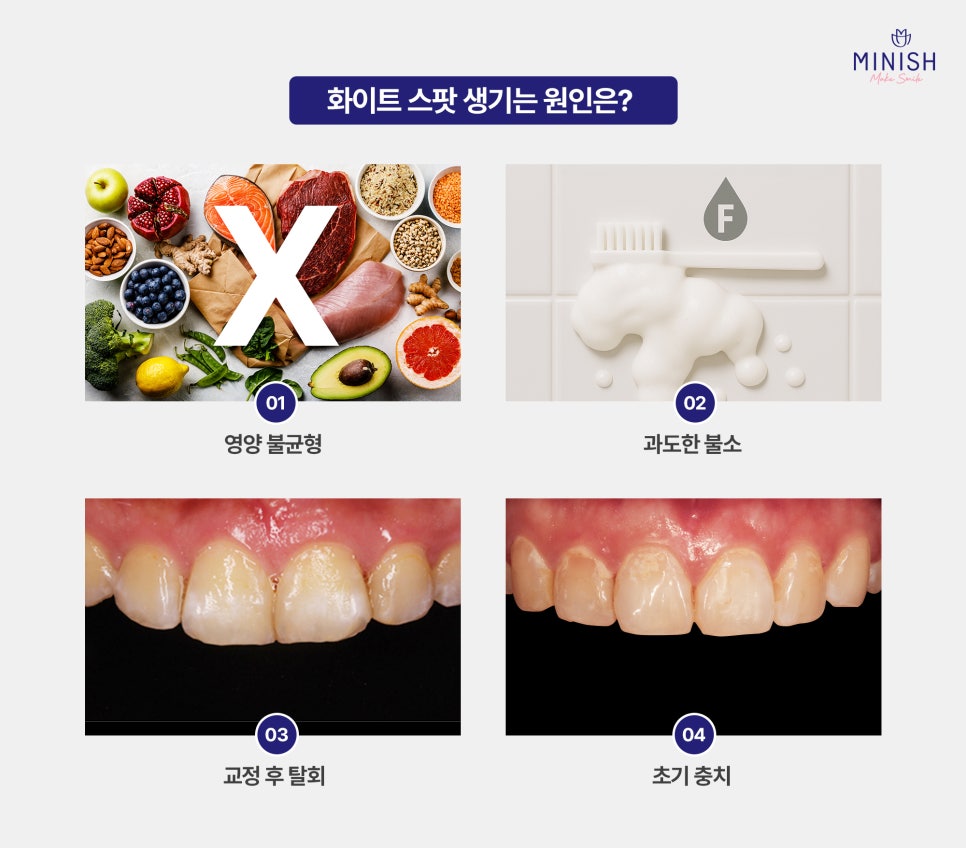 White Spots on Teeth: Worried About White Stains on Your Teeth? Here’s How to Improve Them Healthily! image 3