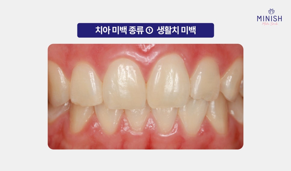 Yellow Teeth Concerns: Teeth Whitening Methods That Vary by Cause image 3