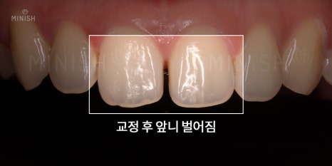 압구정 치과가 추천하는 벌어진치아 교정방법? 관련 이미지 3