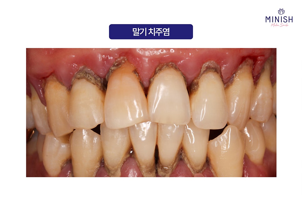 Swollen Gums and Bleeding? Warning Signs of Periodontal Disease image 6