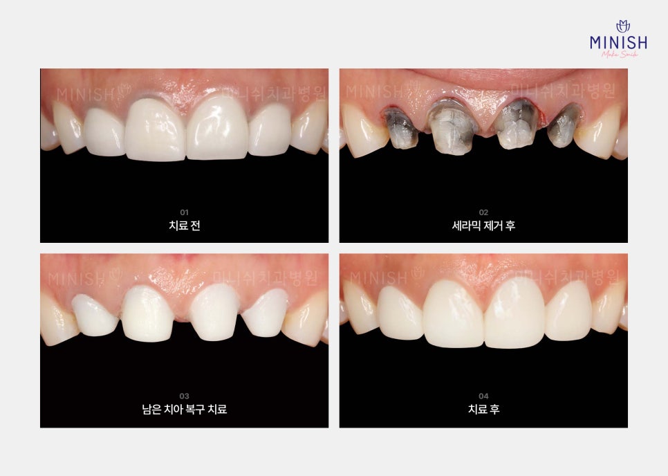 If You’re Considering Laminate Retreatment, Be Sure to Learn About the Side Effects and Healthy Restoration Methods! image 5