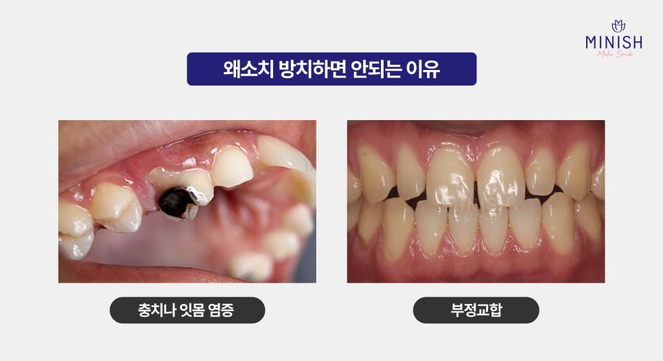 Small Teeth, Hypodontia: What Is a Healthy Way to Improve Them? image 3