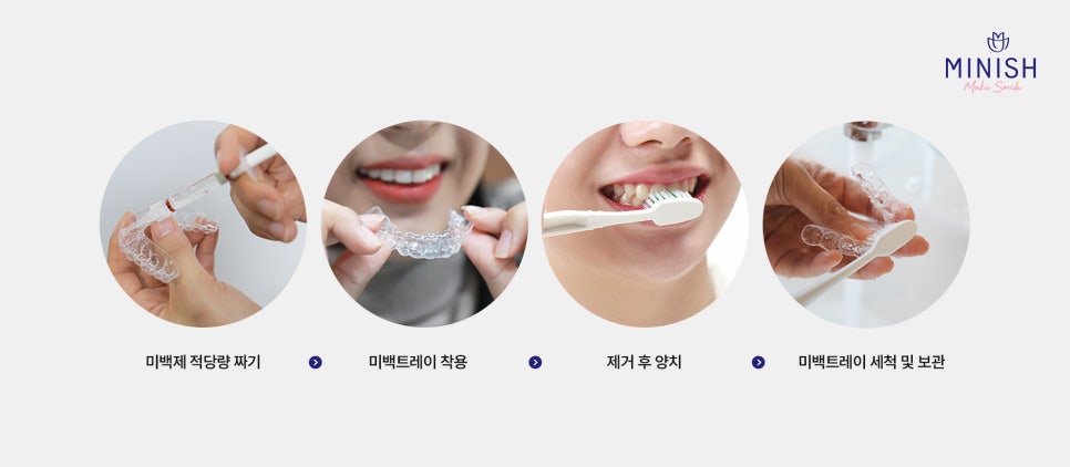 누런치아, 치아 미백으로 해결되지 않을 땐? 관련 이미지 6