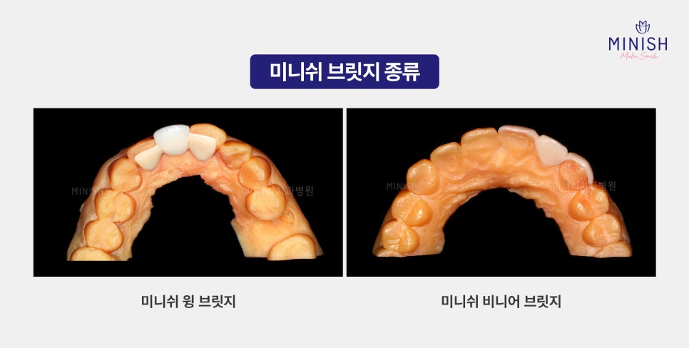 치아 브릿지 vs 미니쉬 브릿지 : 내 치아를 지키는 최적의 선택은? 관련 이미지 3