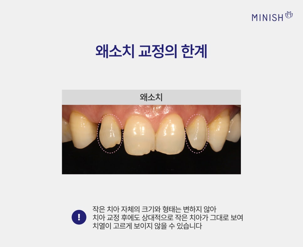 왜소치 교정만으로 작은치아 고민이 해결되지 않을 땐? 미니쉬 심플 관련 이미지 3