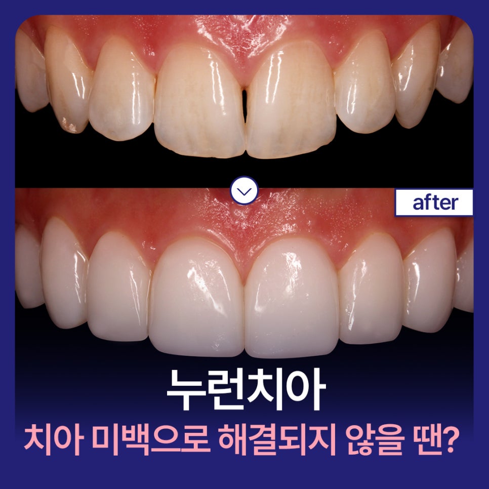 누런치아, 치아 미백으로 해결되지 않을 땐? 관련 이미지 1