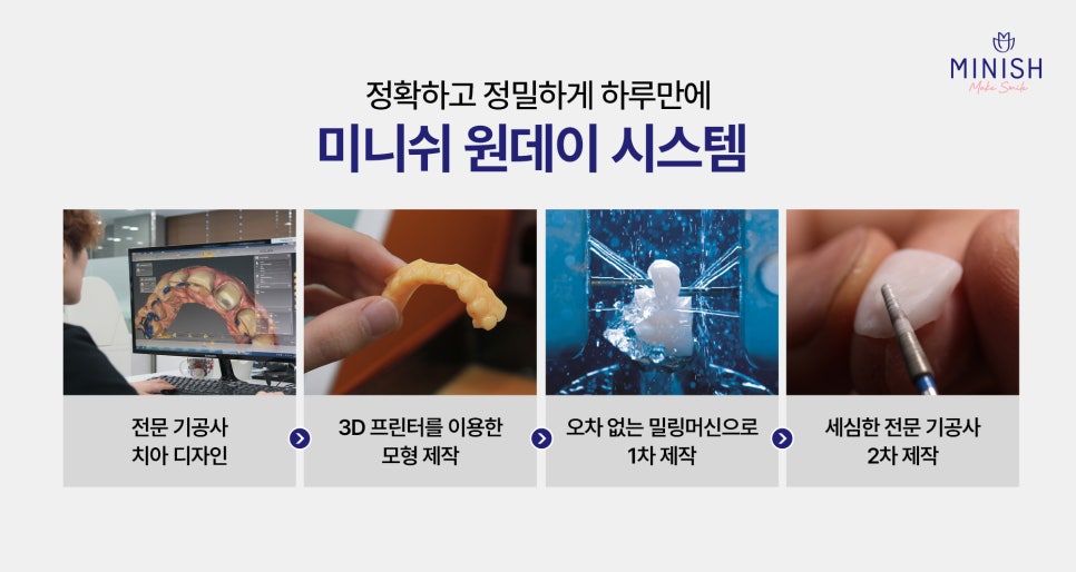 앞니깨짐 레진 치료의 한계와 치아복구솔루션 미니쉬 특장점 관련 이미지 6