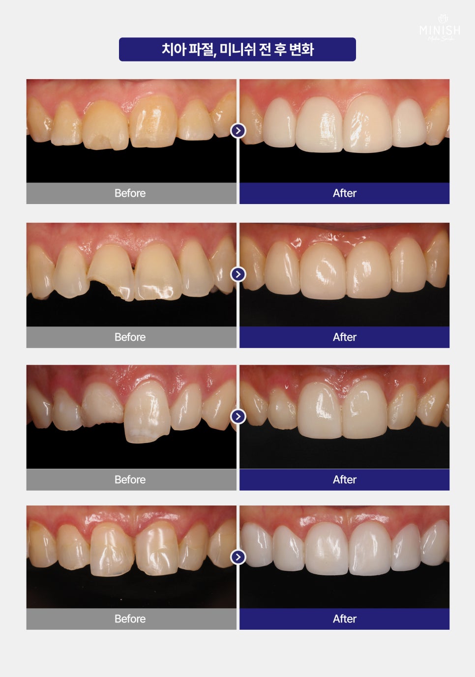 What If a Tooth Breaks? A Complete Summary of Tooth Fracture Treatment Methods and Their Pros and Cons image 5