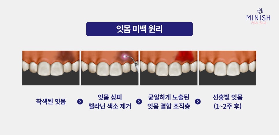 Yellow Teeth Concerns: Teeth Whitening Methods That Vary by Cause image 15