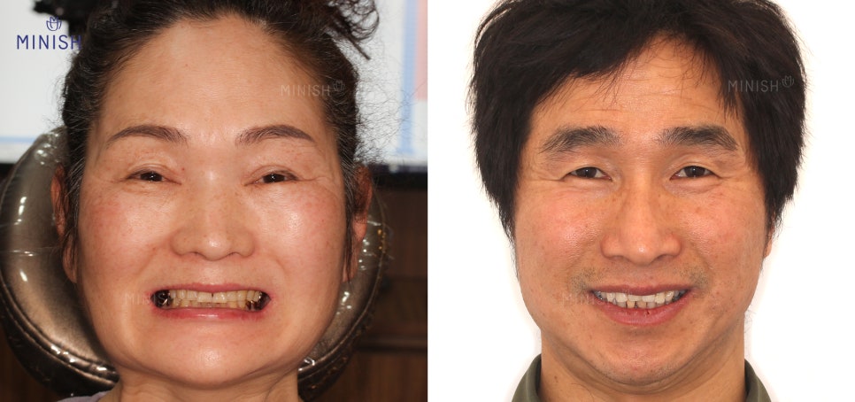 치아마모, 벌어짐 등 노화 증상을 겪는 50대를 위한 학동치과 관련 이미지 3