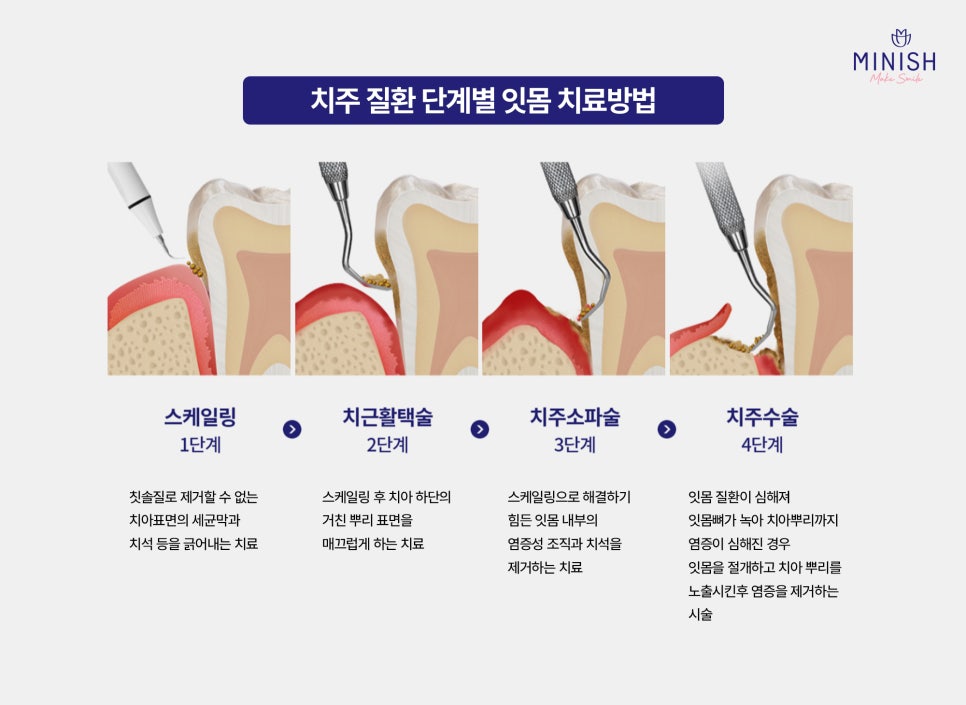 If Gum Swelling Continues, Suspect Periodontal Disease image 5