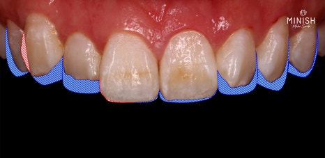 Is It Possible to Straighten Teeth in Just One Day? image 3
