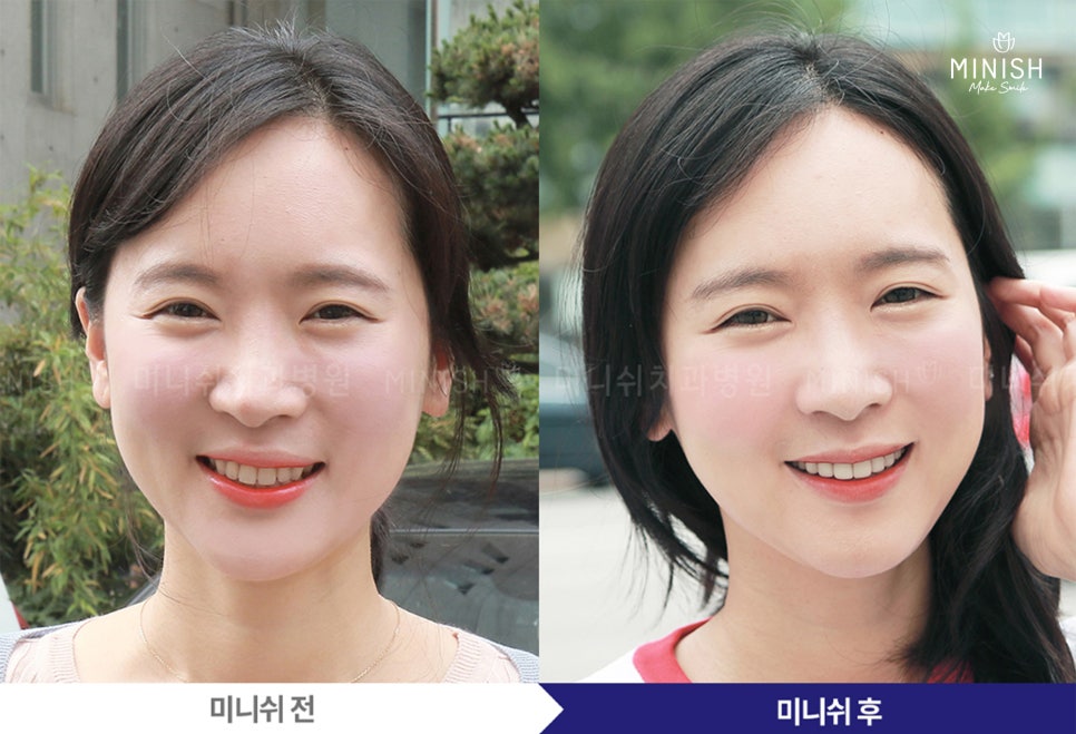 누런 치아? 치아변색 원인과 치료방법은? 관련 이미지 9