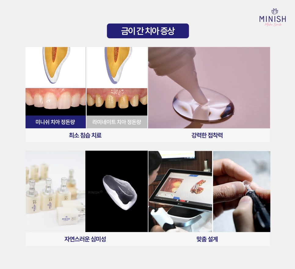 이갈이로 인한 치아마모, 미니쉬로 해결하세요! 관련 이미지 3