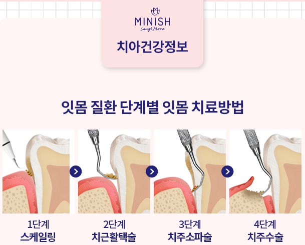 잇몸염증은 구강 적신호...가장 적극적인 잇몸치료는 미니쉬 관련 이미지 16