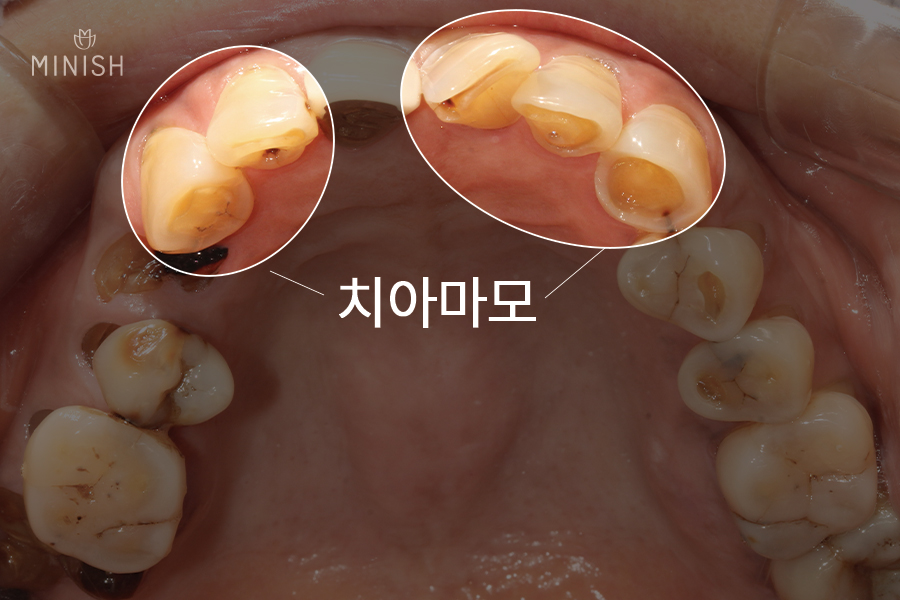 치아실금 방치하면 큰일! 치아코팅으로 건강 되찾으세요 [엄마는예뻤다치과] 관련 이미지 4