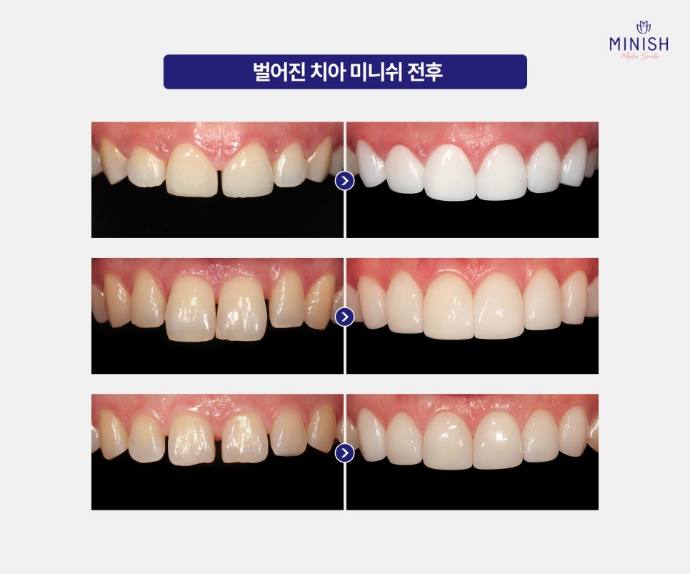 Worried About Gaps Between Your Teeth? Solve It Quickly with Minish While Protecting Your Natural Teeth! image 6