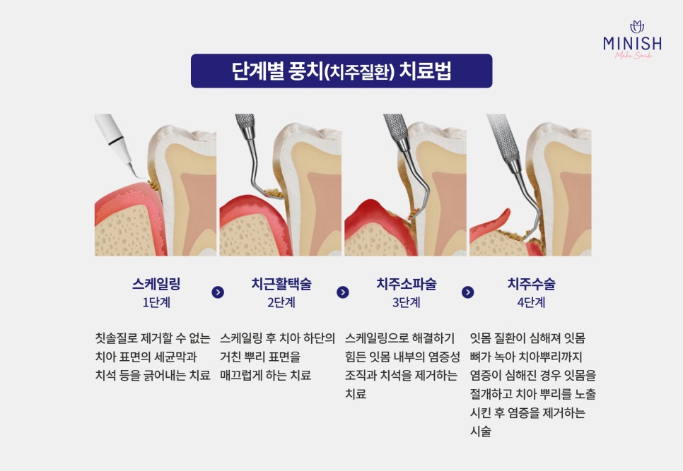 풍치치료 한계 잇몸내려앉음 핑크미니쉬로 해결! 관련 이미지 5