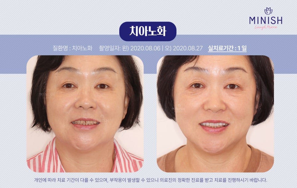 치아 수명 연장하는 법 관련 이미지 2