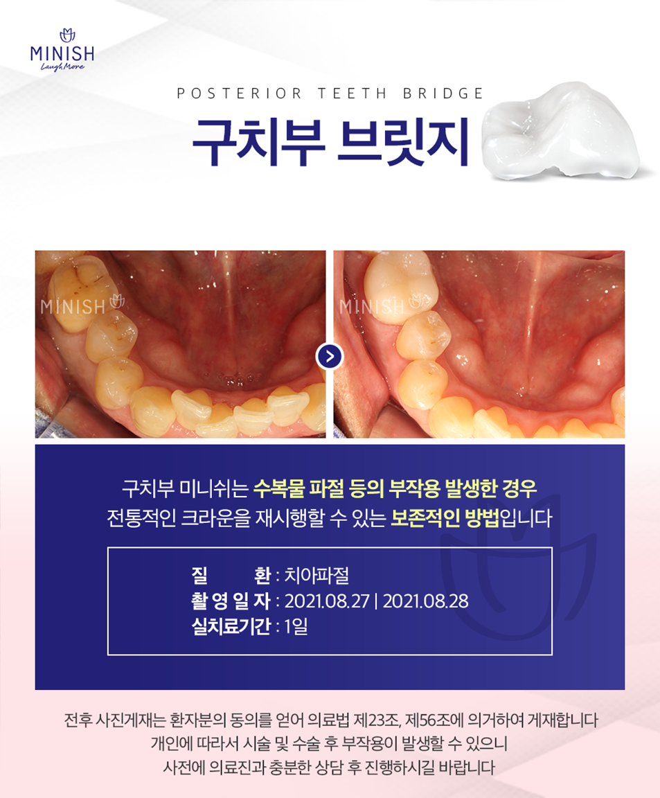 어금니깨짐 방치 하지말고 어금니미니쉬로 개선해보시기 바랍니다. 관련 이미지 3
