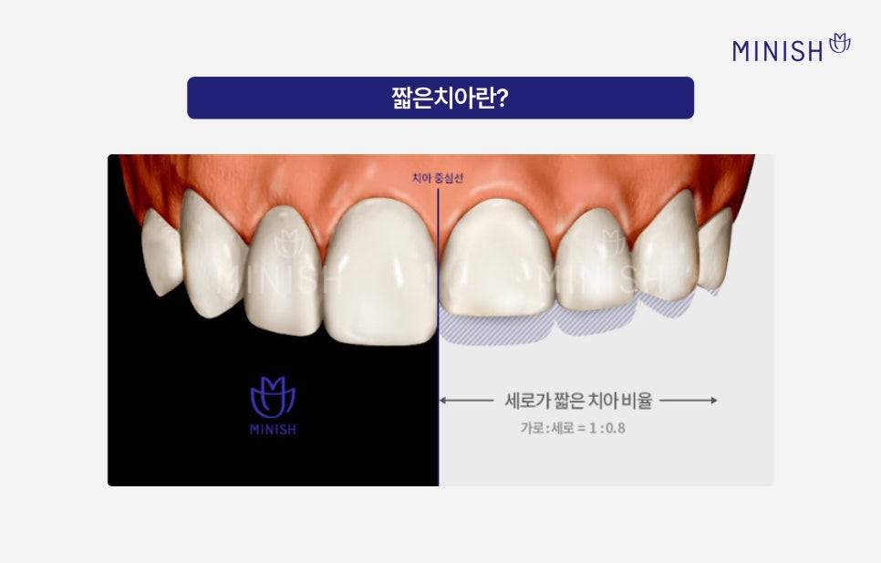 앞니가 짧아 보인다면? 짧은치아 원인과 앞니 미니쉬 관련 이미지 2