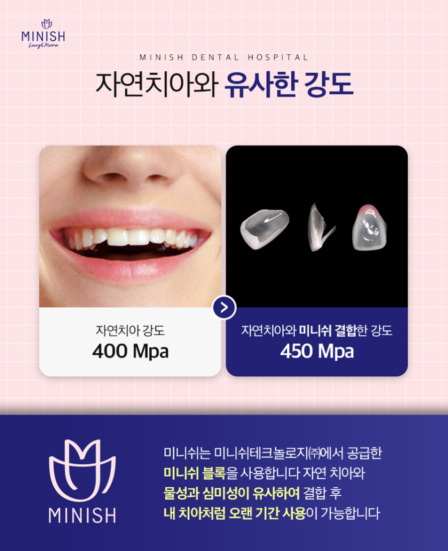 강남구치과, 벌어지고 깨진 치아 미니쉬로 정교하게 개선! 관련 이미지 5