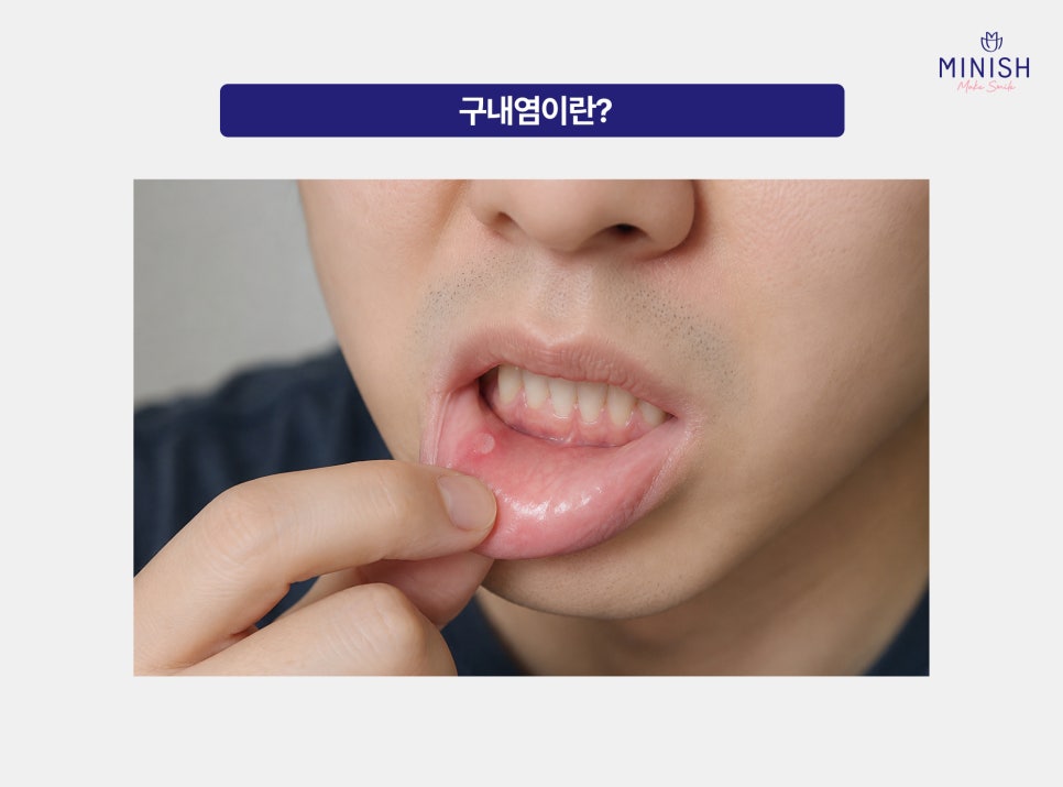 구내염 원인부터 빨리 낫는 법까지, 자꾸 생기는 이유는? 관련 이미지 2