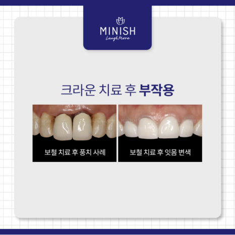 크라운치료의 거의 모든 것 관련 이미지 3