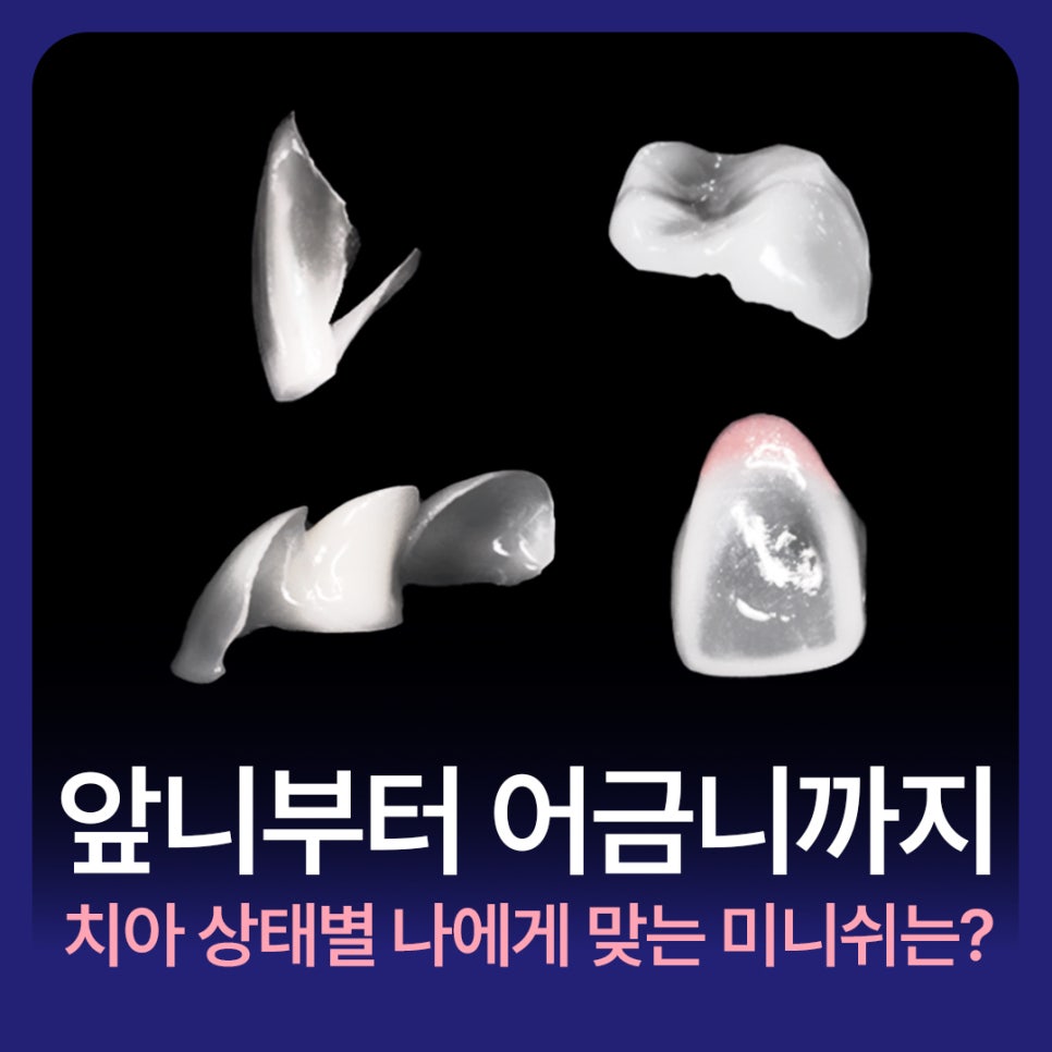 From Front Teeth to Molars, Which Minish Is Right for My Dental Condition? image 1