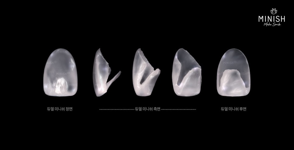 치아 파절? 치아가 깨졌다면 미니쉬로 건강과 심미성을 모두 복구하세요! 관련 이미지 5