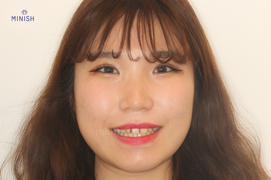 치아벌어짐 고민하지 말고 원데이미니쉬로 빠르게 관련 이미지 1