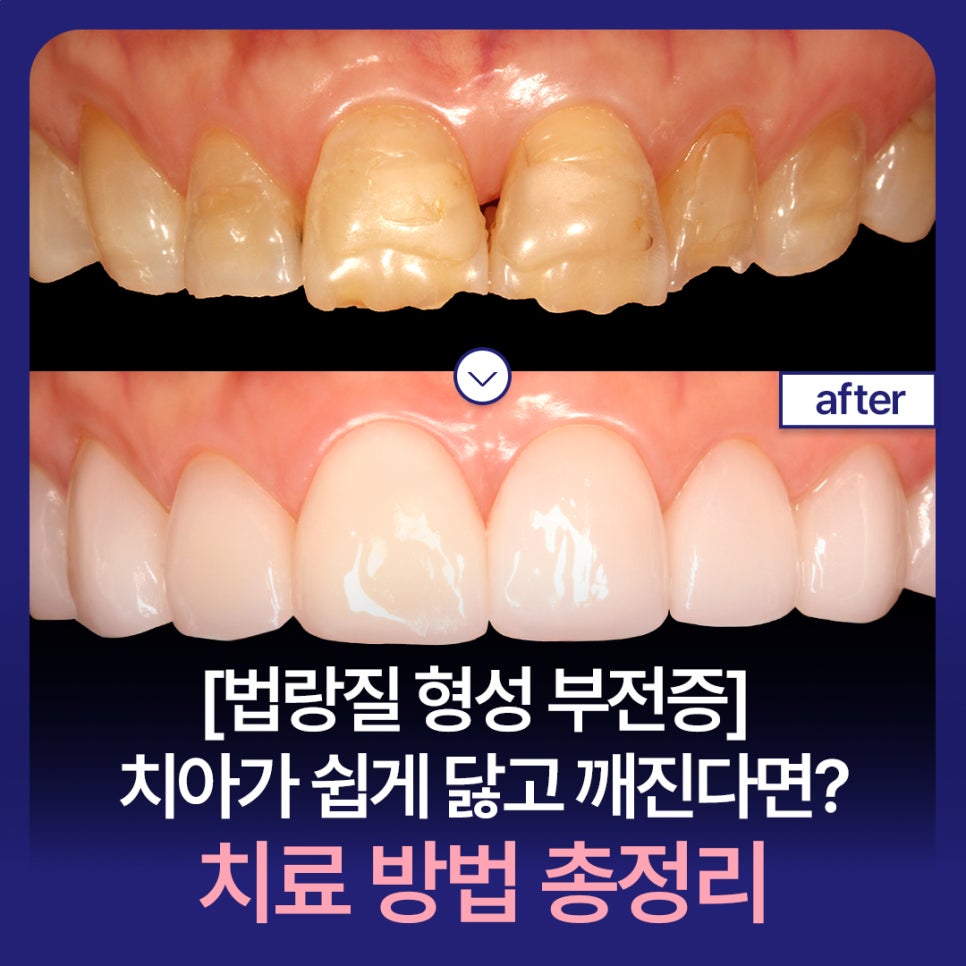 [Amelogenesis Imperfecta] If Your Teeth Wear Down and Break Easily, What Are the Treatment Options? Complete Guide image 1