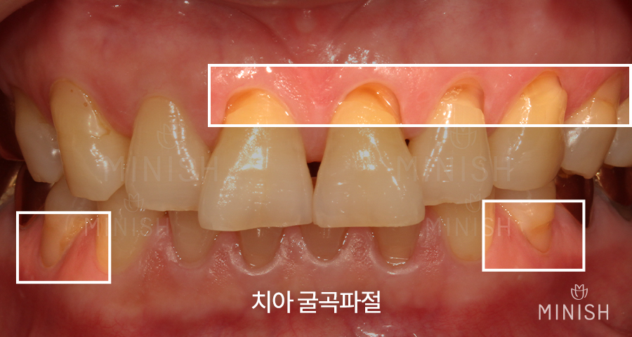 [Tooth Aging] Do Teeth Age, Too? Restoring Them Healthily with Minishe image 6