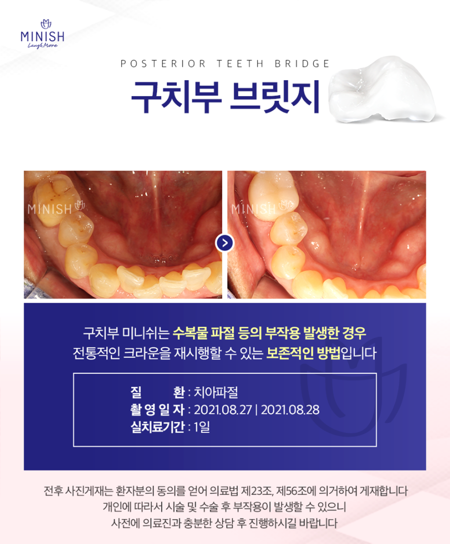 압구정치과 손상된 치아 기능과 심미성을 동시에 높여주는 미니쉬 관련 이미지 8