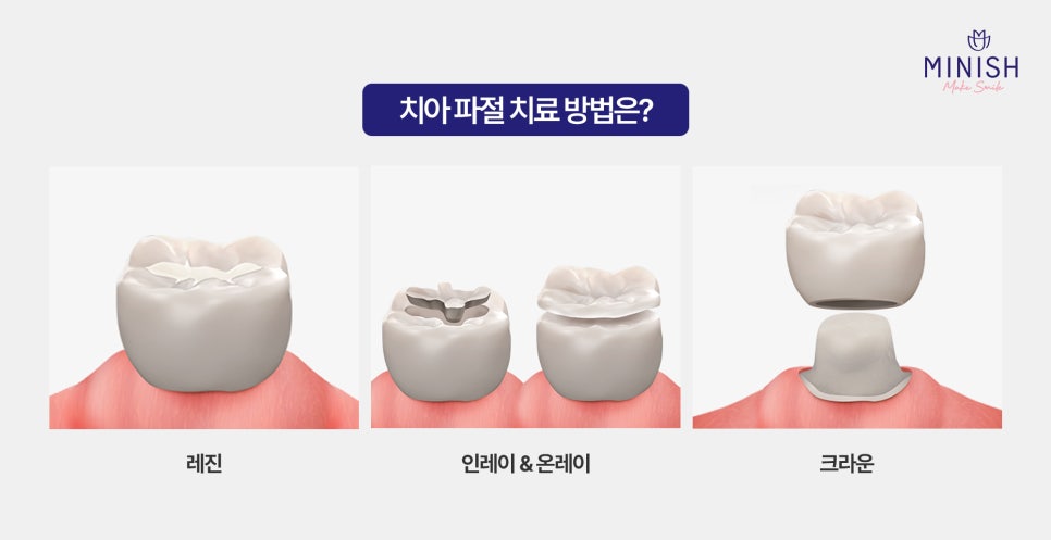 치아 파절? 치아가 깨졌다면 미니쉬로 건강과 심미성을 모두 복구하세요! 관련 이미지 3