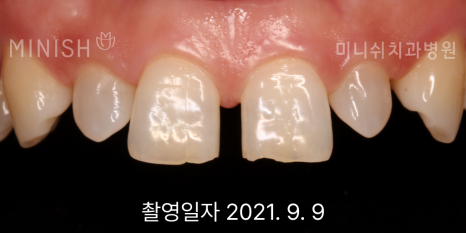 벌어진 앞니 치료 방법 세가지 장단점 관련 이미지 5