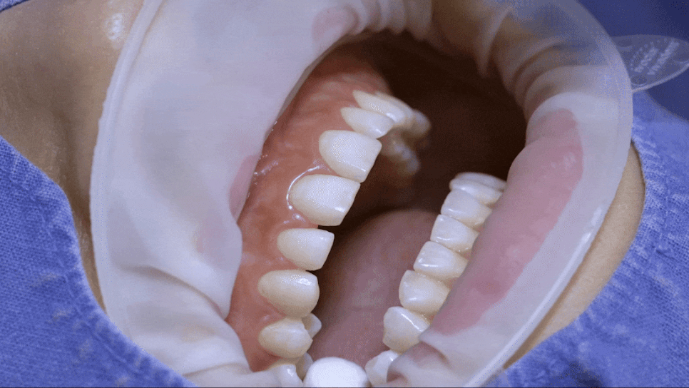 When Crown Retreatment Is Needed: The Tooth Restoration Solution Minish image 5