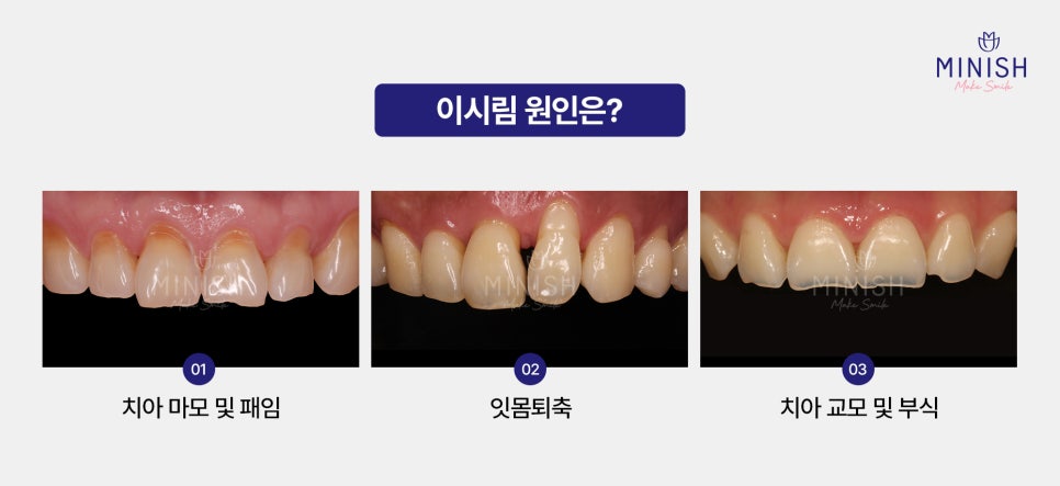 Cold Water Alone Makes Your Teeth Sensitive? A Complete Guide to Causes and Treatment! image 2