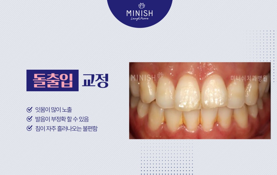 부정교합종류, 하루만에 교정할 수 있는 방법도 있을까? 관련 이미지 3