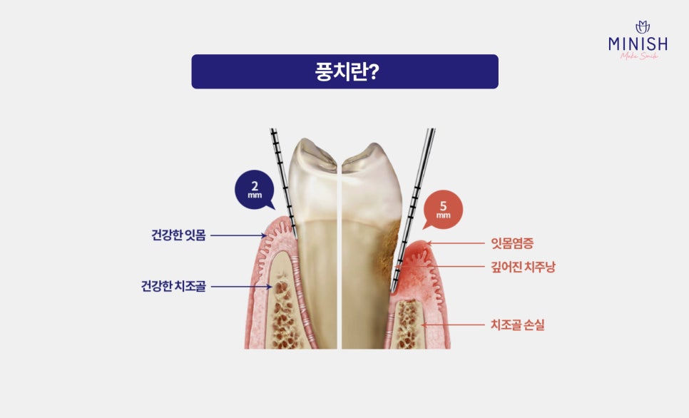 If This Sensitivity Continues, You May Be Developing Periodontal Disease image 2