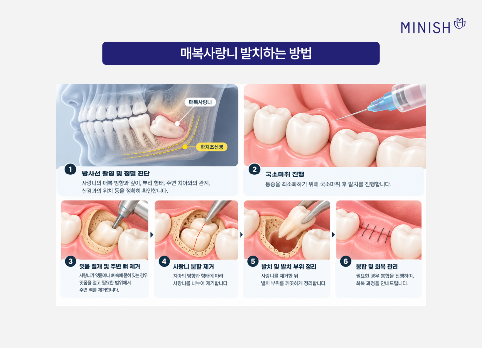 매복사랑니 통증, 발치 꼭 해야 하나요? 관련 이미지 5