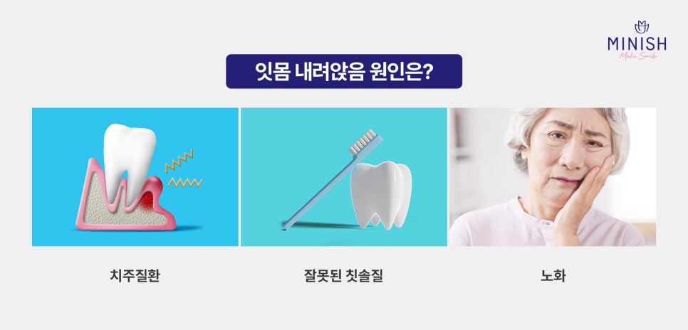 잇몸 내려앉음 치료 방법은? 원인과 증상까지! 관련 이미지 2