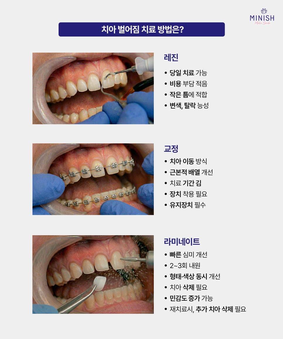 치아 벌어짐 왜 생길까요? 원인부터 치료 방법까지 관련 이미지 4