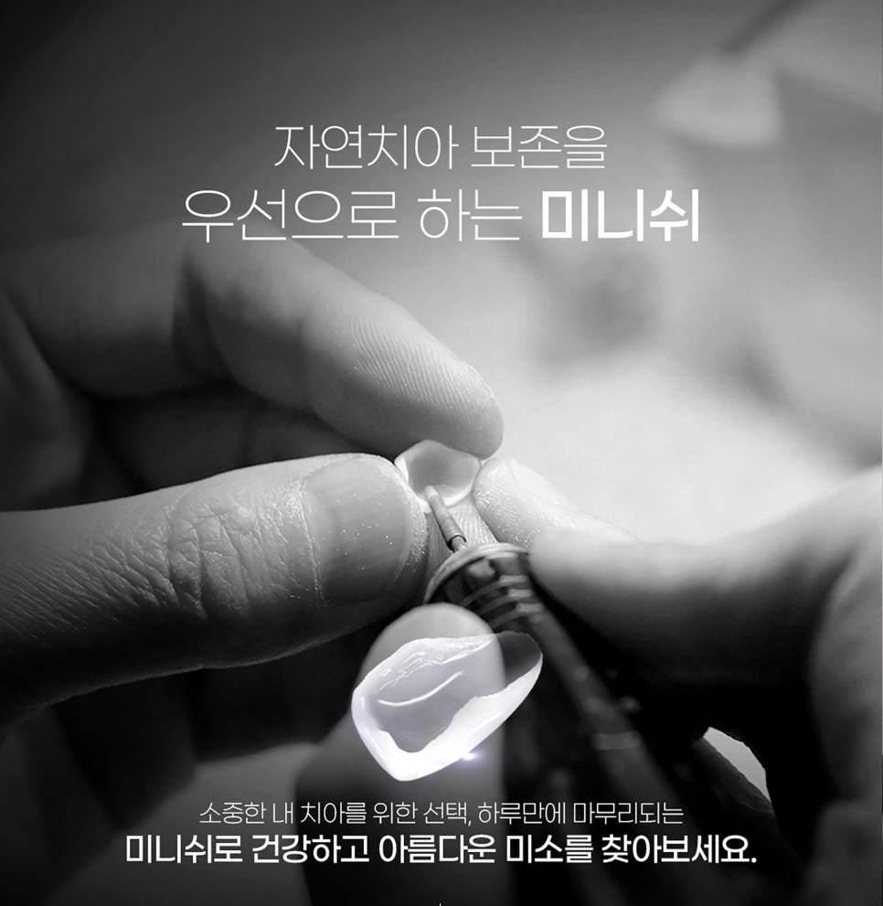 벌어진 앞니 치료 방법 세가지 장단점 관련 이미지 11