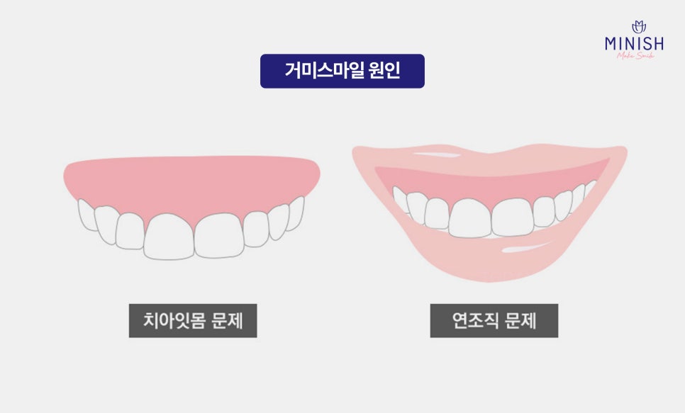 웃을 때 잇몸 과다 노출, 거미스마일 잇몸성형 알아보신다면? 관련 이미지 3
