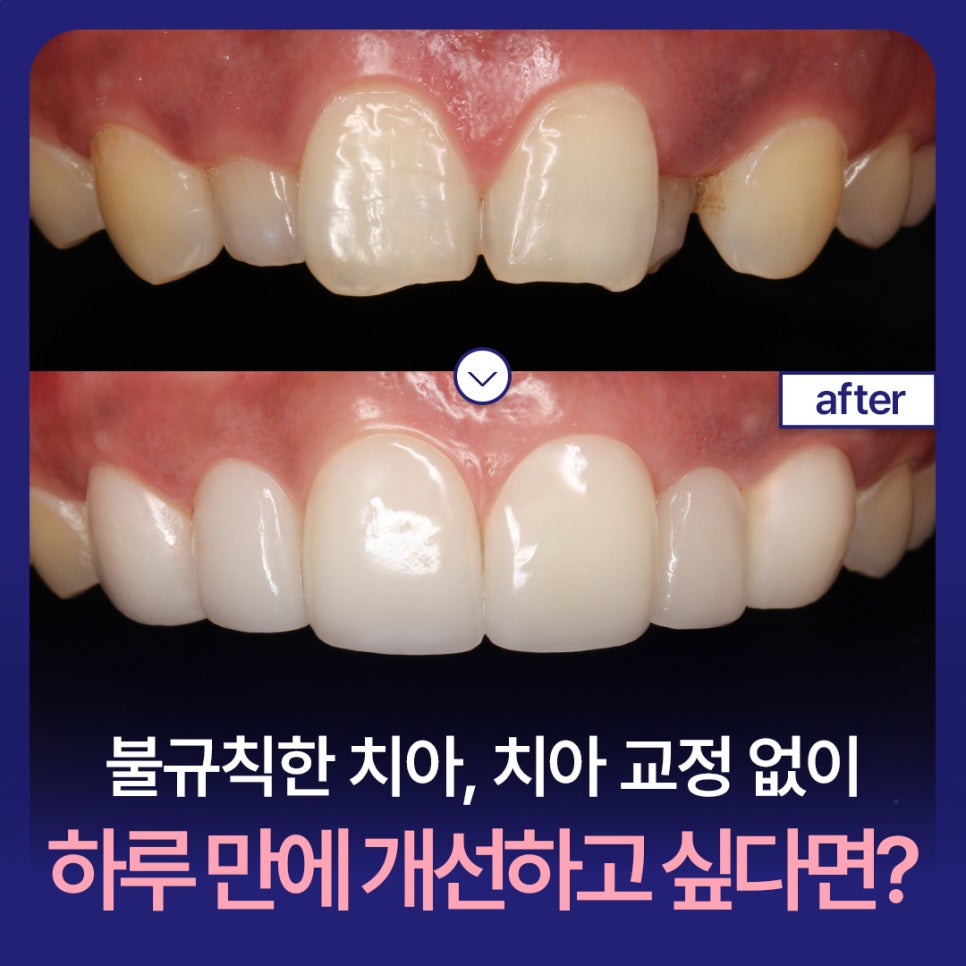 If You Want to Improve Irregular Teeth in Just One Day Without Orthodontics image 1