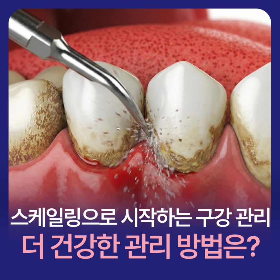 Oral Care Starting with Scaling: What Is a Healthier Way to Manage It? image 1