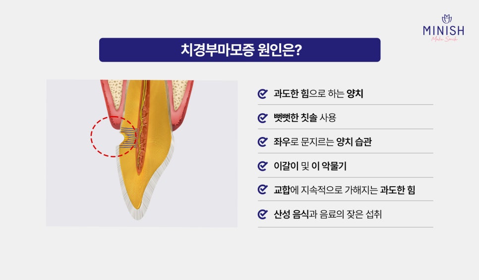 Cervical Abrasion, Causes of Exposed Tooth Roots, and Treatment for Gum Indentations image 3